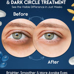 Under Eye Cream for Puffiness and Bags Under Eyes 1 fl oz Eye Bags Treatment for Men Women Anti Wrinkle Cream for Dark Circles Baggy Eyes Treatment for Women with Retinol Hyaluronic Acid & Caffeine